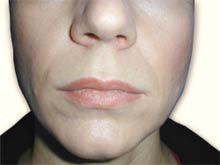 Before Collagen Injections