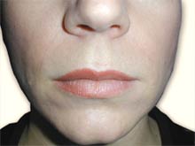 After Collagen Injections