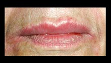 After Collagen Injections